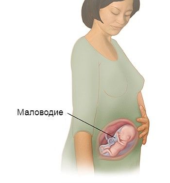 Маловодие при беременности: причины, симптомы и лечение