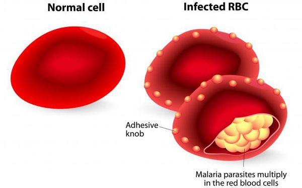 какое состояние крови развивается в результате малярии