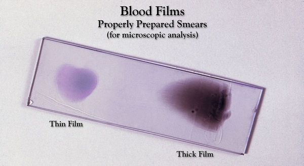 Микроскопия крови методом толстой капли