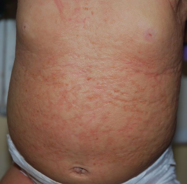 Диффузный кожный мастоцитоз [19]