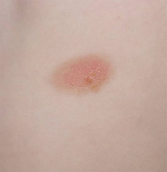 Мастоцитома [10]