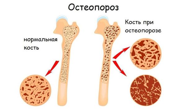 Остеопороз