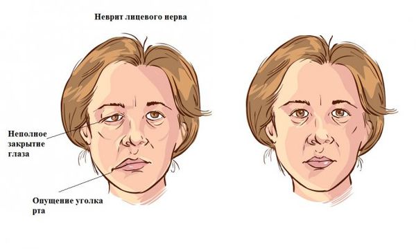 Симптомы неврита лицевого нерва