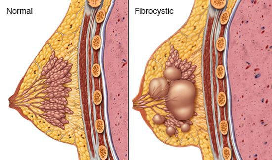 Молочная железа в норме и при фиброзно-кистозной мастопатии