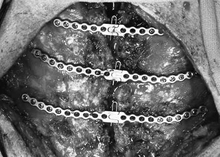 Фиксация грудины [15] (нажмите на изображение, чтобы увидеть его)