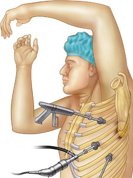 Хирургическое лечение