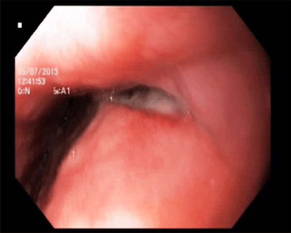 Перфорация пищевода [13]