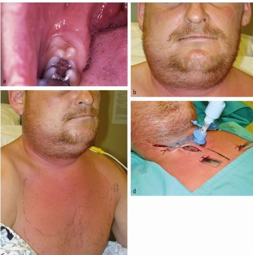 Трахеостомия [9]