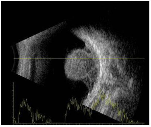 Меланома хориоидеи при УЗИ [1]