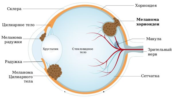 Строение глаза. Меланома хориоидеи [33]