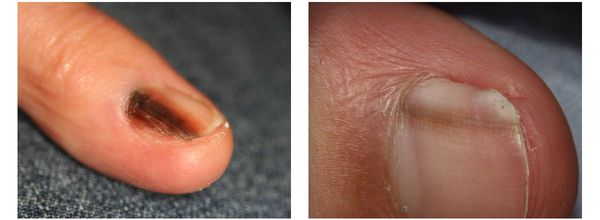 Меланома на ногтевой пластине