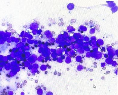Мелкоклеточный рак под микроскопом при цитологическом анализе [5]