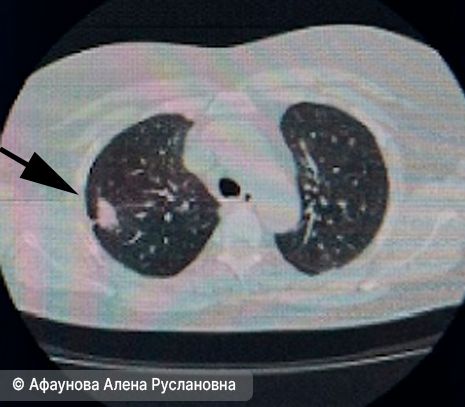 Периферический рак правого лёгкого 