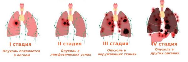 Стадии рака лёгких