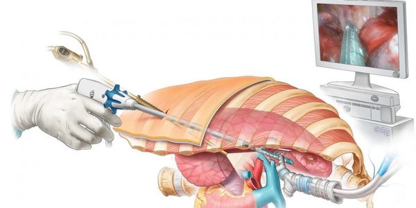 Трансторакальная биопсия лёгкого