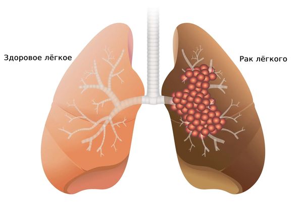 Злокачественное образование в лёгком