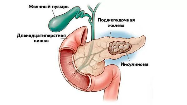 Инсулинома