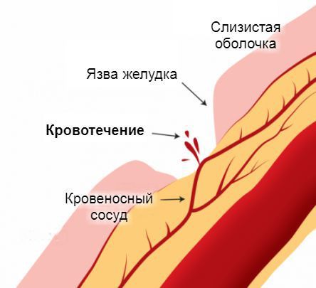 Кровотечение на фоне язвы желудка