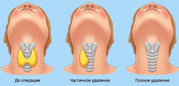 Тиреоидэктомия