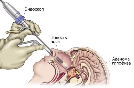 Удаление аденомы гипофиза Удаление аденомы гипофиза