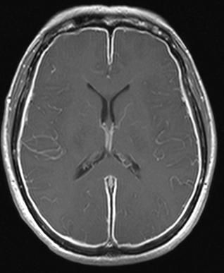 МРТ головного мозга при менингите