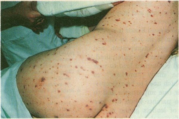 Сыпь при менингококковой инфекции [20]