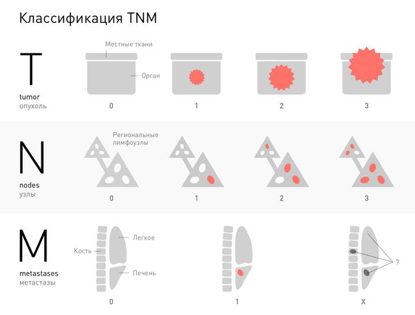 TNM классификация опухолей