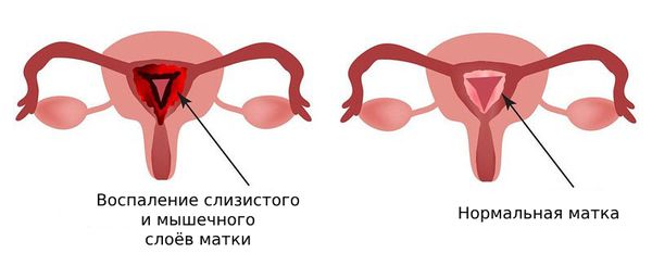 Метроэндометрит
