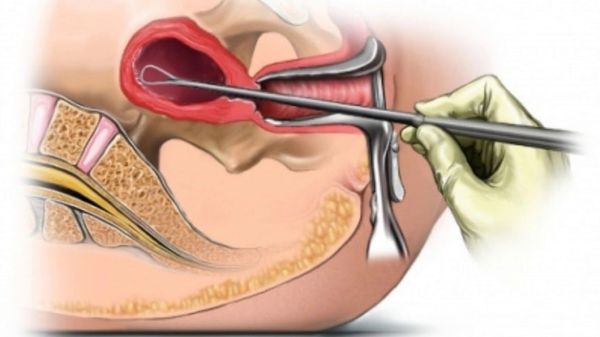 Выскабливание полости матки