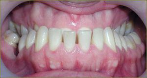 Нижние зубы перекрывают зубы верхней челюсти