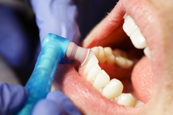 prishlifovyvanie zubov s