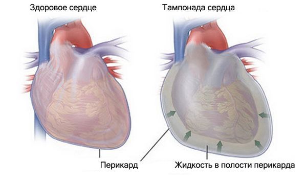 Тампонада сердца Тампонада сердца