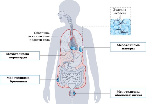 Возможное расположение мезотелиомы [16]