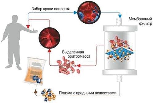 Плазмаферез