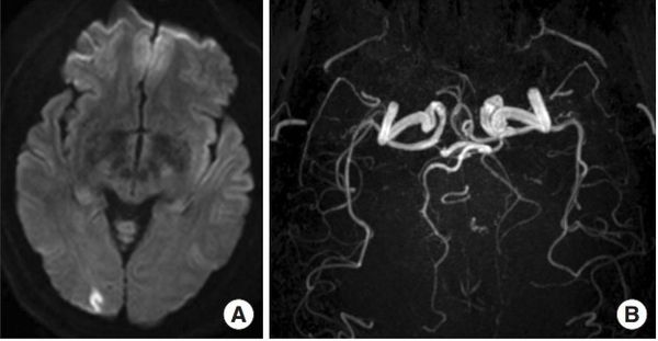 Нейровизуализация мигренозного инсульта [42]