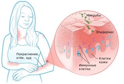 Лечение экземы на ногах