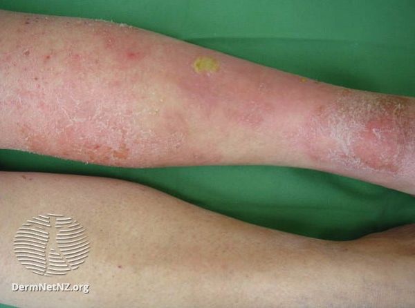 The strategy of selecting topical therapy for microbial eczema