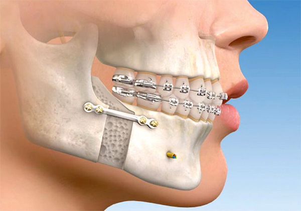 Крепление нижней челюсти после операции