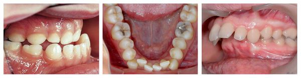 Нарушения со стороны зубов: мезиальный прикус, скученность зубов и дистальный прикус
