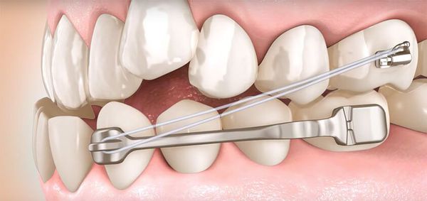 Ортодонтическое исправление прикуса