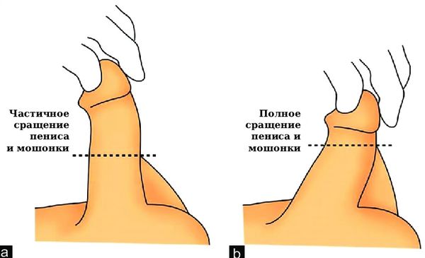 Варианты перепончатого полового члена [25]