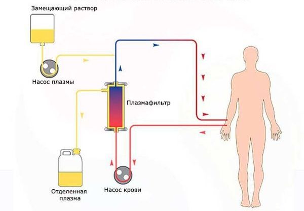 Плазмаферез