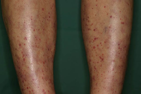 Проявления МПА на коже [29]