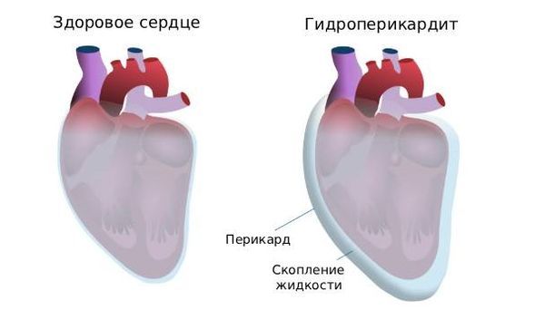 Гидроперикардит