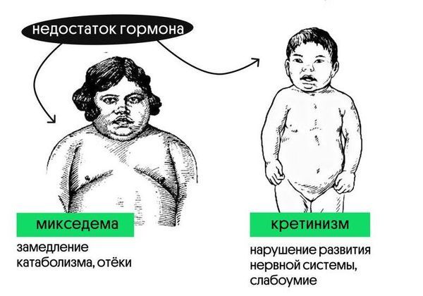 Проявления осложнённого гипотиреоза