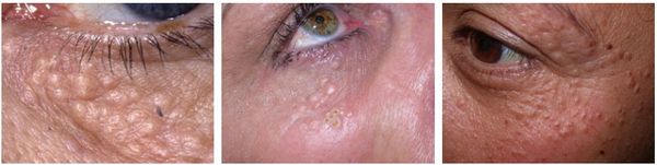 Сирингома [21]