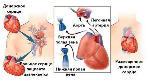 Трансплантация сердца