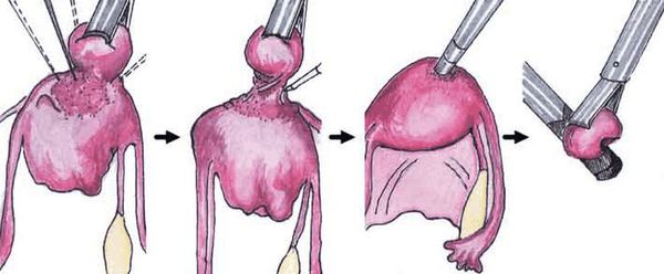 Миомэктомия Миомэктомия