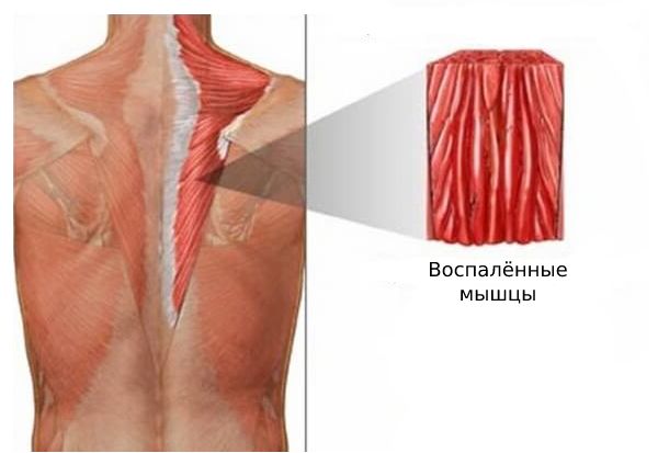Миозит: причины, симптомы и лечение в статье терапевта Шувалова И. Н.