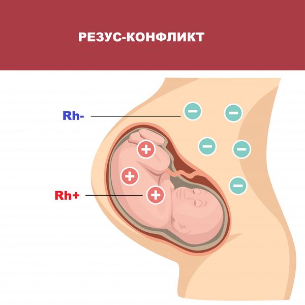 Резус-конфликт